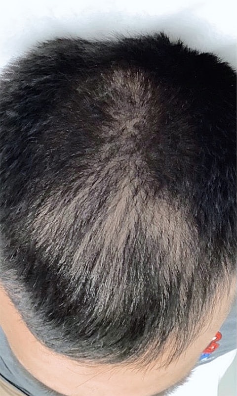 Close-up of a balding scalp from above.