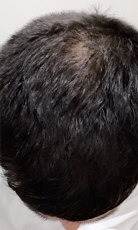 Top view of thinning hair on scalp.