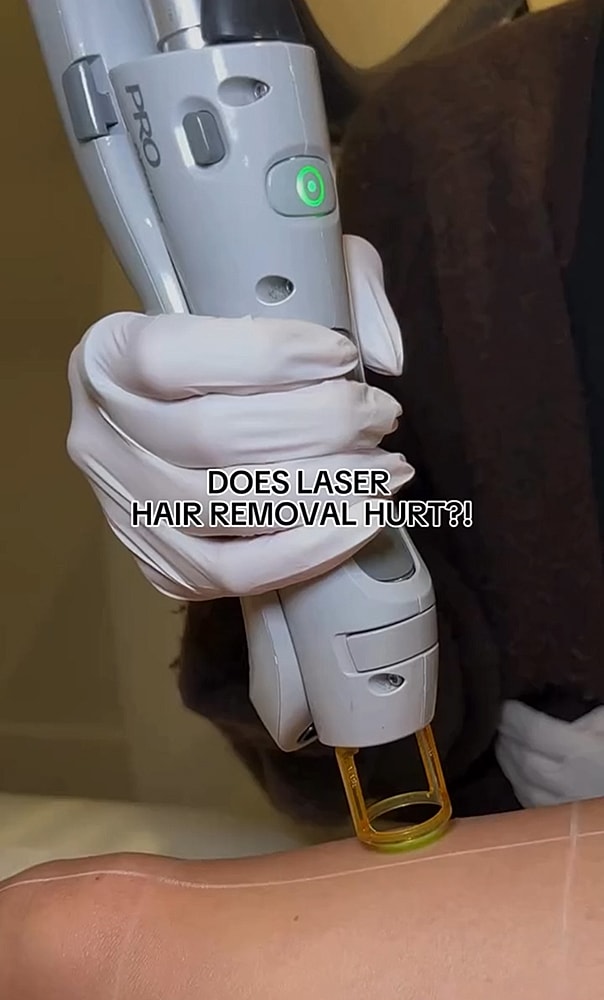 Laser hair removal procedure being performed on skin.
