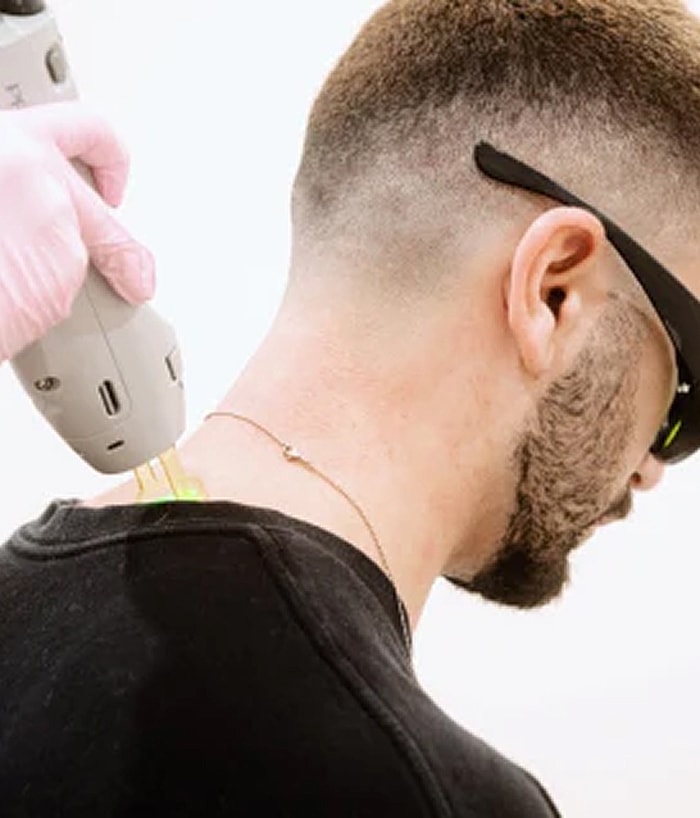 Laser hair removal treatment in progress.