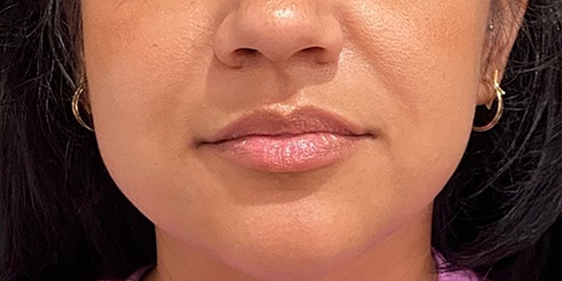 Lip Fillers Before & After