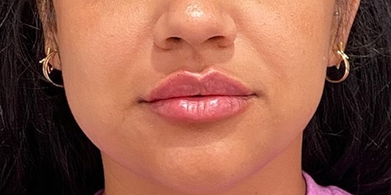 Lip Fillers Before & After