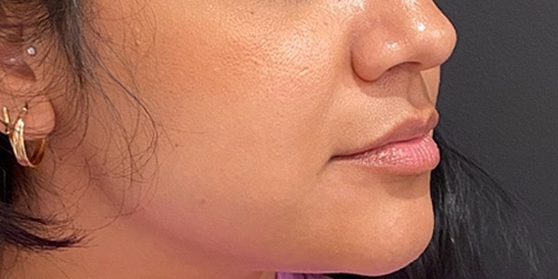 Lip Fillers Before & After