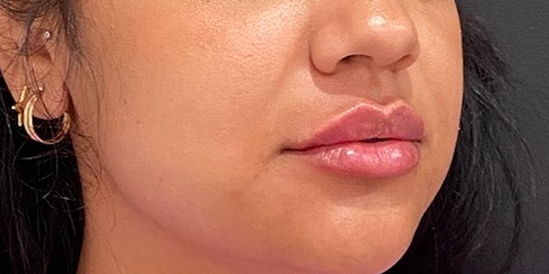 Lip Fillers Before & After