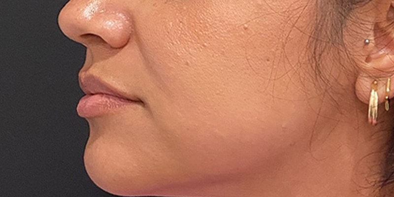 Lip Fillers Before & After