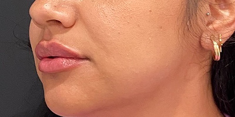 Lip Fillers Before & After