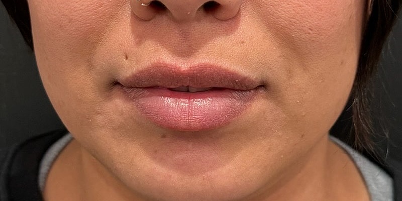 Lip Fillers Before & After