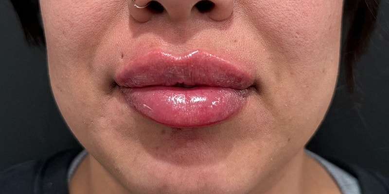 Lip Fillers Before & After