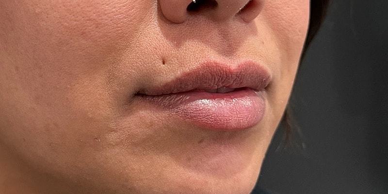 Lip Fillers Before & After