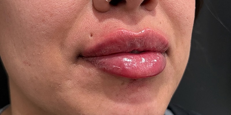 Lip Fillers Before & After