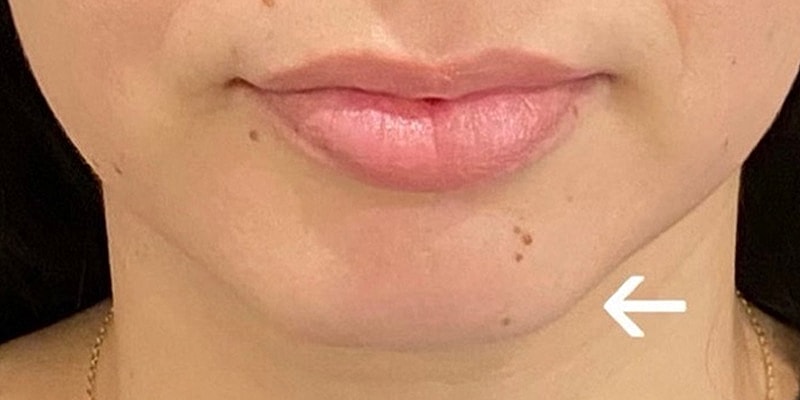 Lip Fillers Before & After