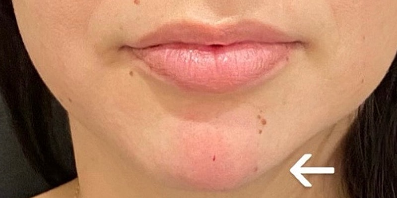 Lip Fillers Before & After