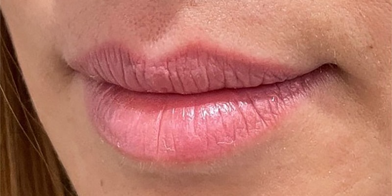 Lip Fillers Before & After