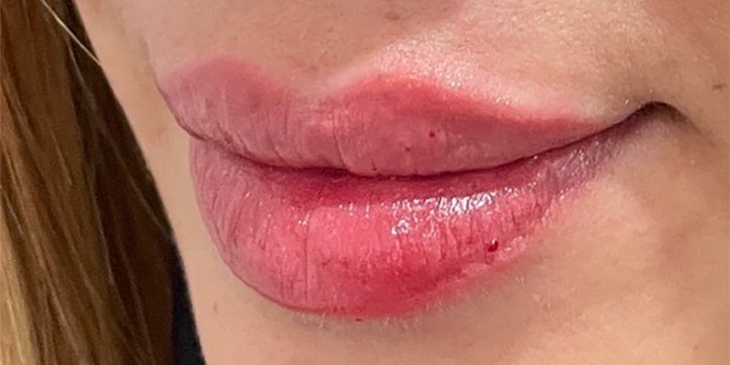 Lip Fillers Before & After