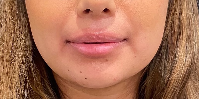 Lip Fillers Before & After
