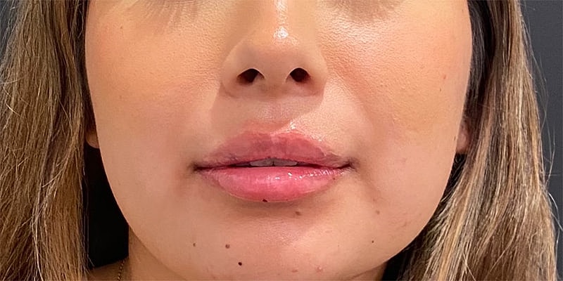 Lip Fillers Before & After
