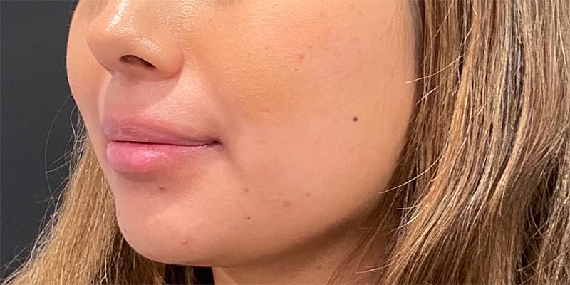 Lip Fillers Before & After