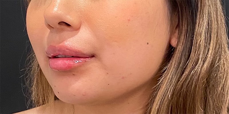Lip Fillers Before & After
