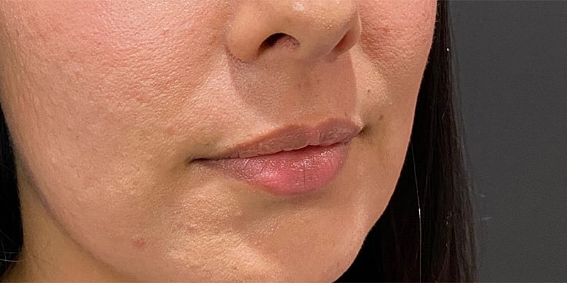 Lip Fillers Before & After