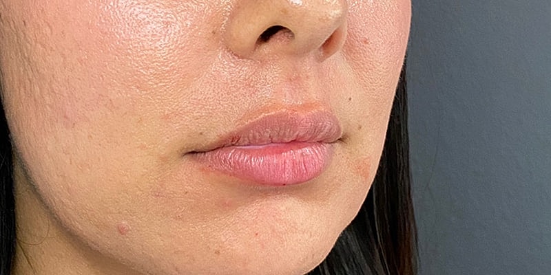 Lip Fillers Before & After