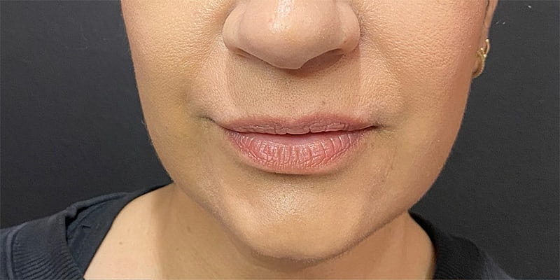 Lip Fillers Before & After