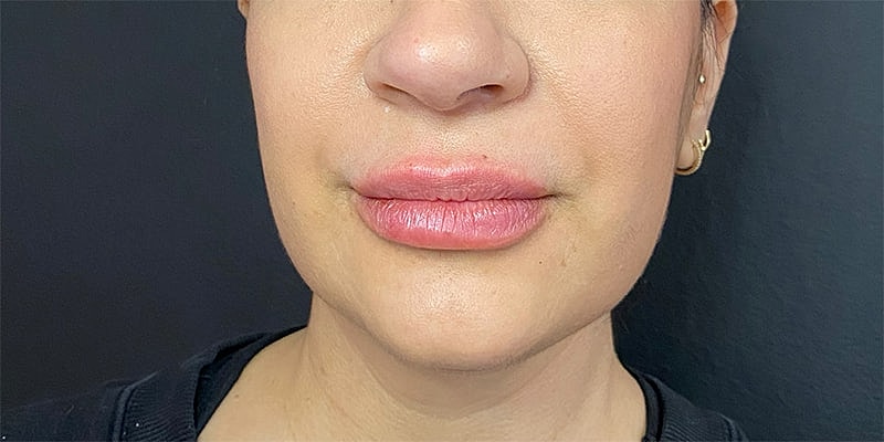 Lip Fillers Before & After