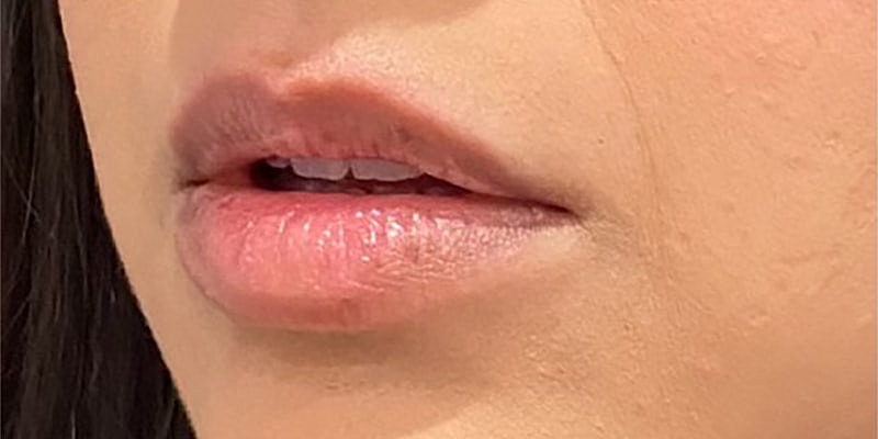 Lip Fillers Before & After