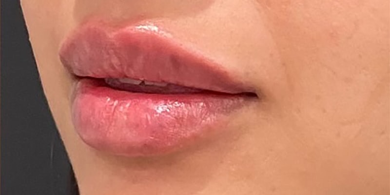 Lip Fillers Before & After