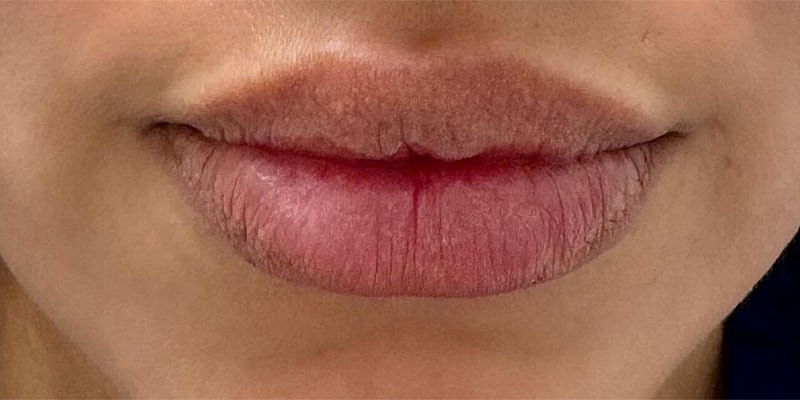 Lip Fillers Before & After