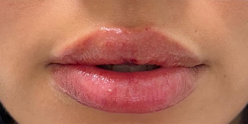 Lip Fillers Before & After