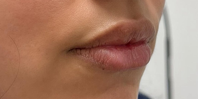 Lip Fillers Before & After