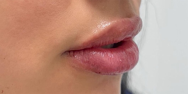 Lip Fillers Before & After