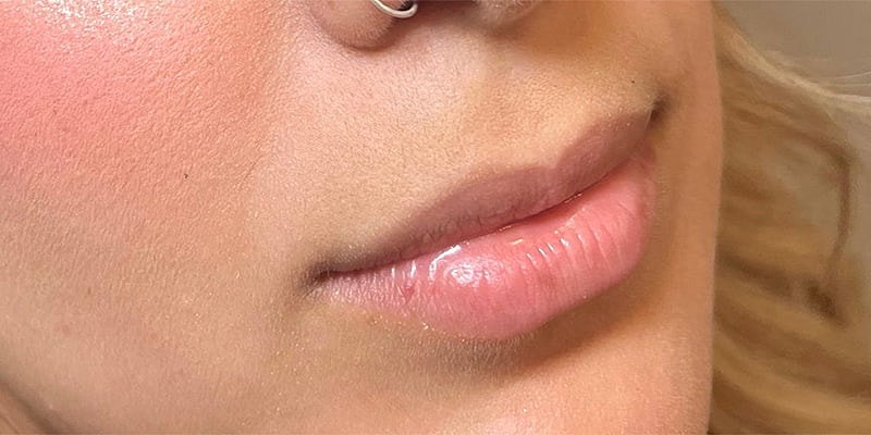 Lip Fillers Before & After