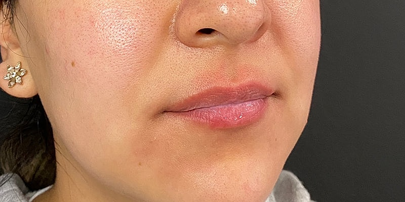 Lip Fillers Before & After