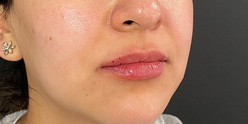 Lip Fillers Before & After