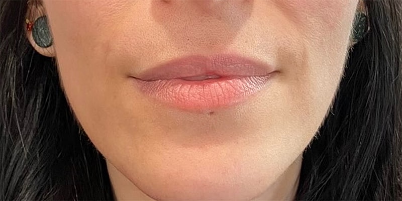 Lip Fillers Before & After