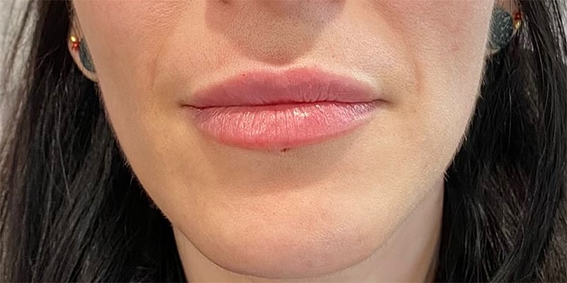 Lip Fillers Before & After