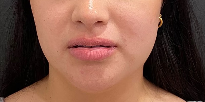 Lip Fillers Before & After