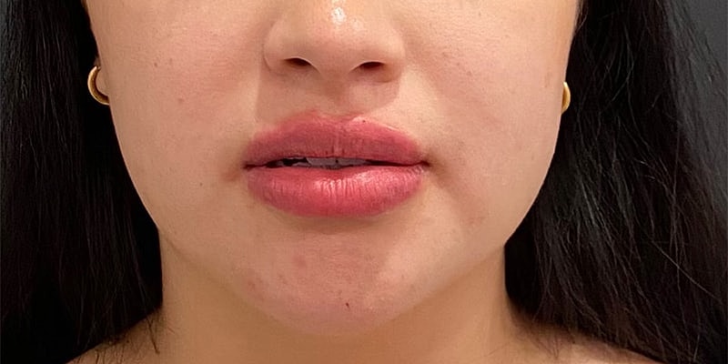 Lip Fillers Before & After