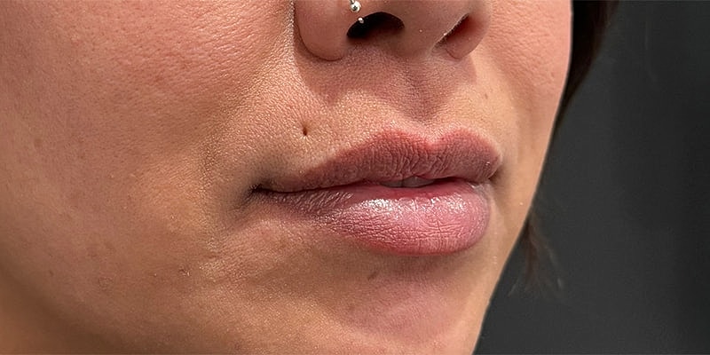Lip Fillers Before & After