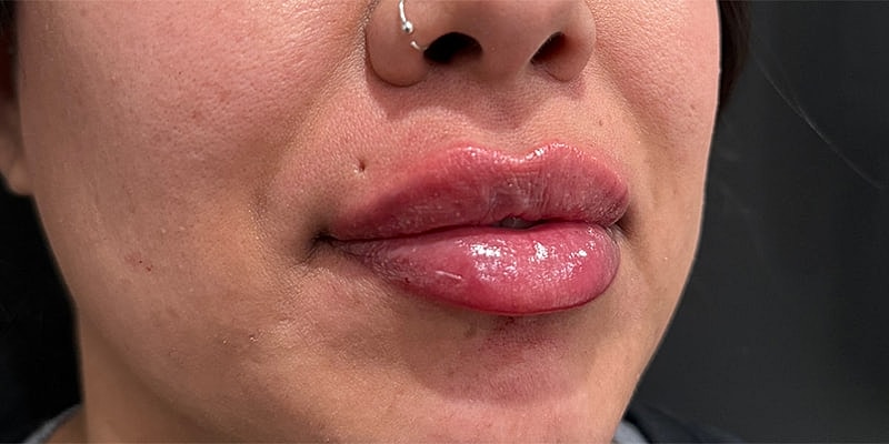 Lip Fillers Before & After