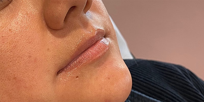 Lip Fillers Before & After