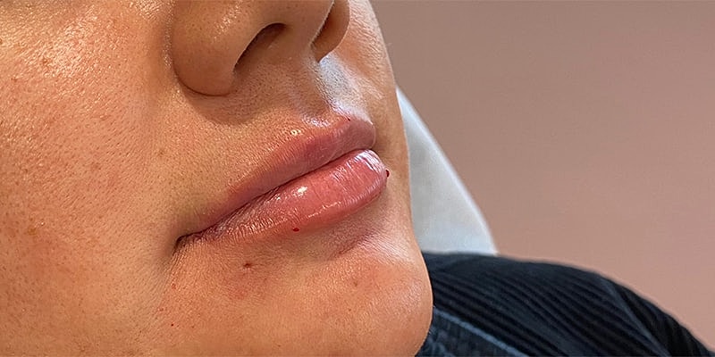 Lip Fillers Before & After