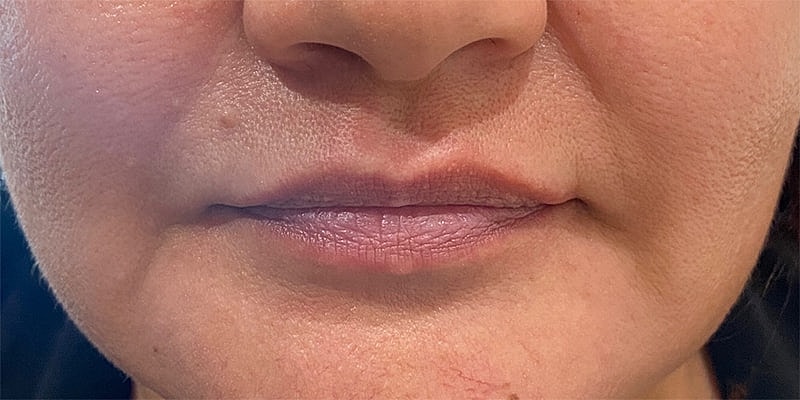 Lip Fillers Before & After