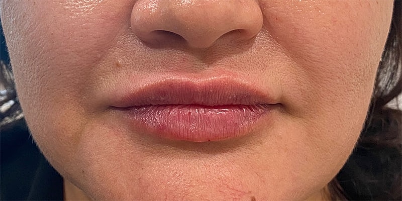 Lip Fillers Before & After