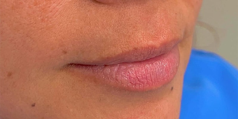 Lip Fillers Before & After