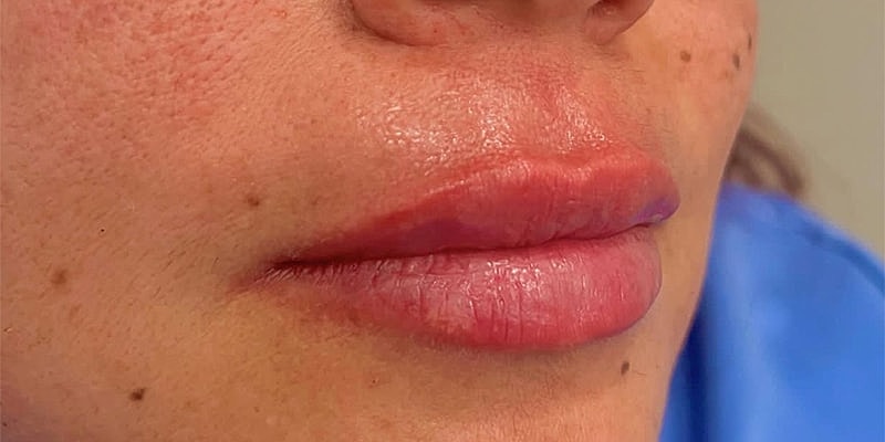 Lip Fillers Before & After