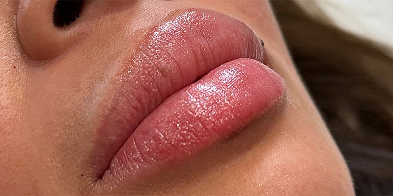 Lip Fillers Before & After