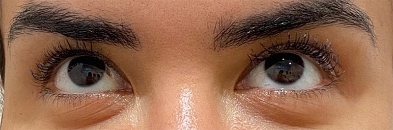 Botox Before & After