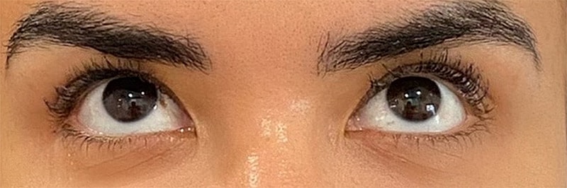 Botox Before & After